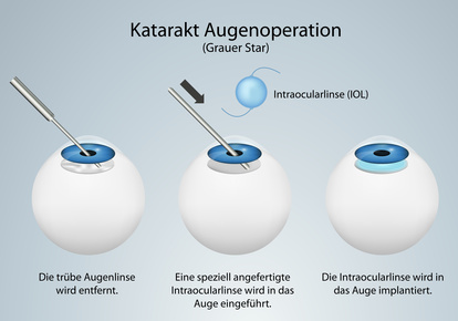 Katarakt Operation